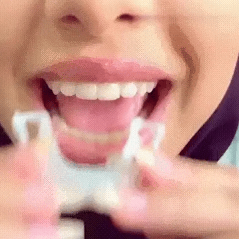 Flex-Smile® Veneers